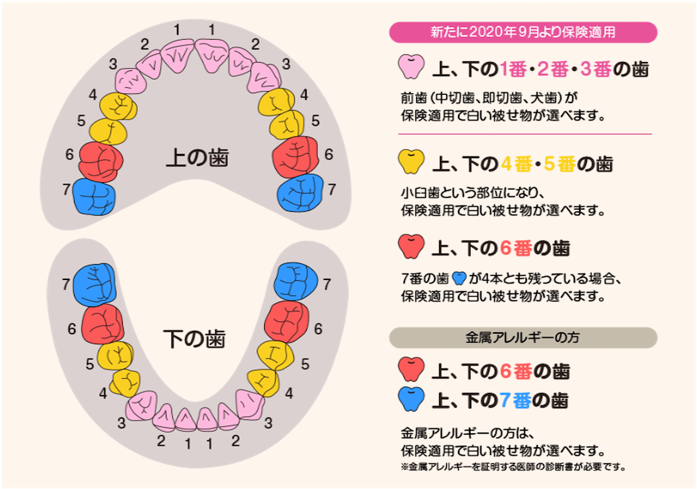 CAD/CAM冠